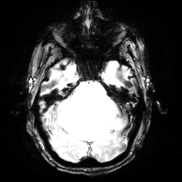 Figure 7: CN (a) MRI (b) PET