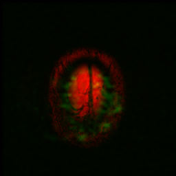 Figure 8: Fused images (a) MRI (b) PET