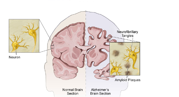 Figure 2: Comparison between Normal and Alzheimer's Disease [27]